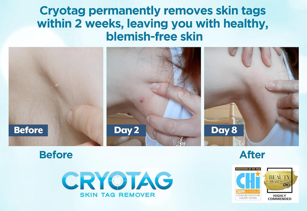 Skin Tag Remover - Fast Effective Safe Skin Tag Removal- Removes Skin Tags in as Little as 1 Treatment, Clinically Proven, up to 12 Treatments